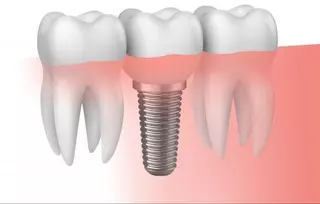 Quinto aniversario:
Implante dental tratamiento completo.